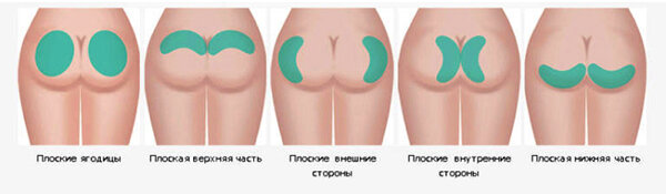 Методы установки ягодичных имплантов