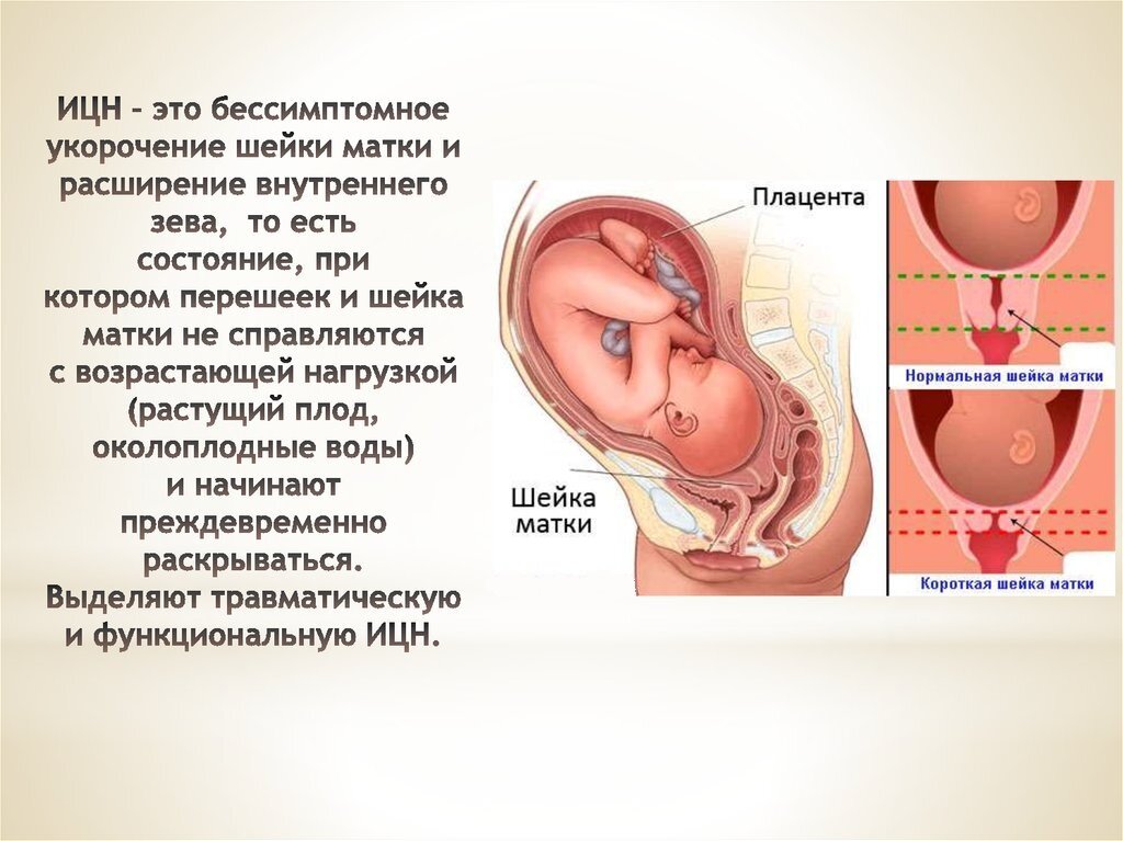 Истмико-цервикальная недостаточность