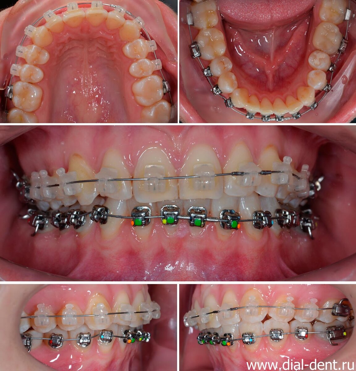 исправление прикуса у взрослого при помощи наружных комбинированных брекетов (металлических и керамических)