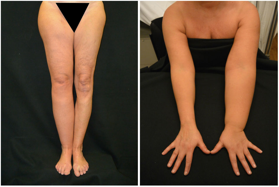 Marlene's Lipedema Story: Part 1 - YouTube