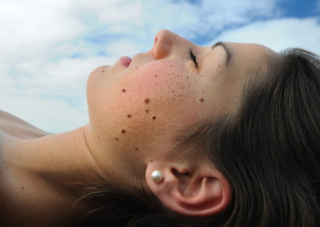 появилось много родинок на лице. появилось много родинок на лице. появилось много родинок на лице. появилось много родинок на лице. появилось много родинок на лице.