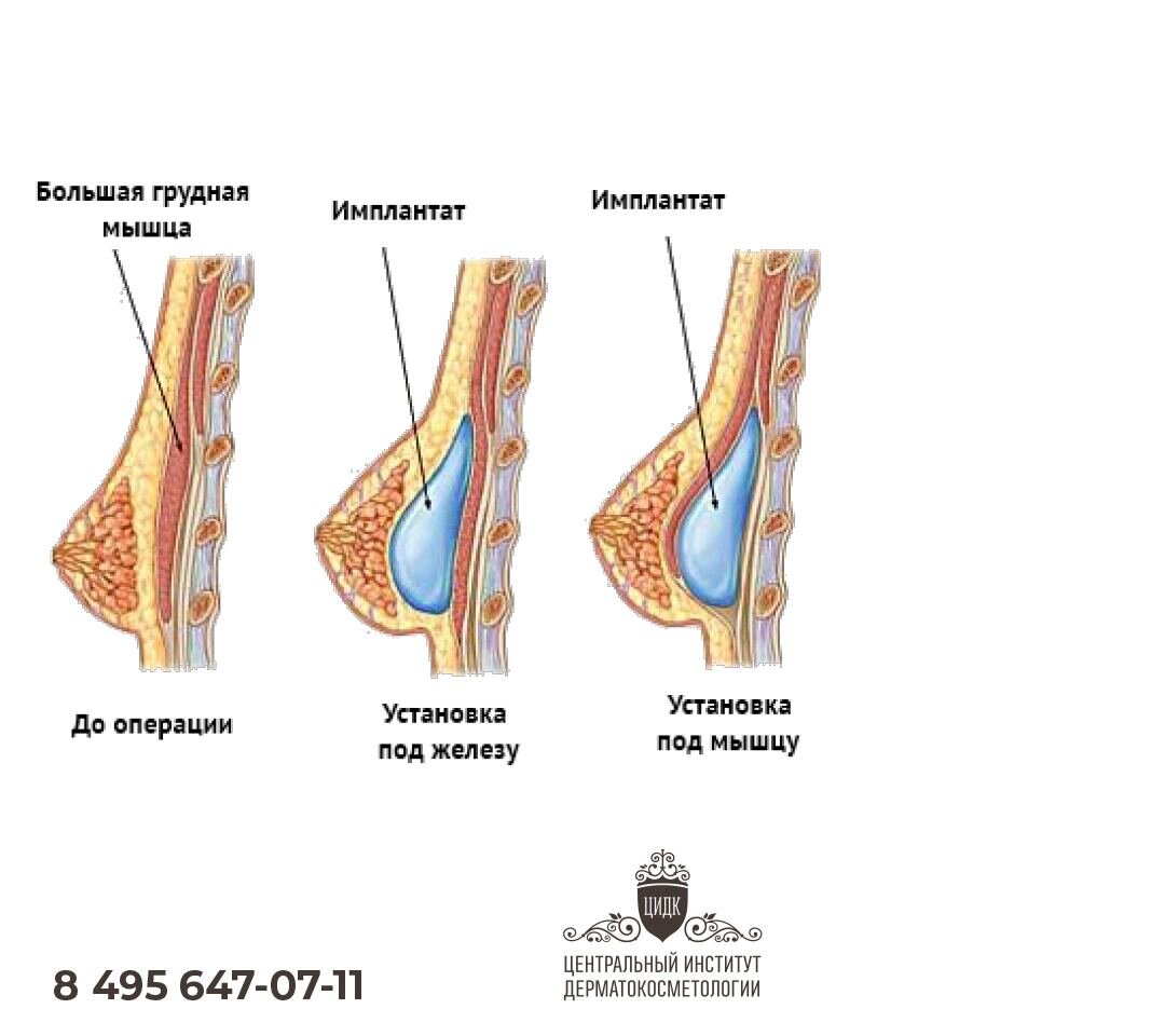 Хочу увеличить грудь... | ЦИДК Клиника косметологии | Дзен