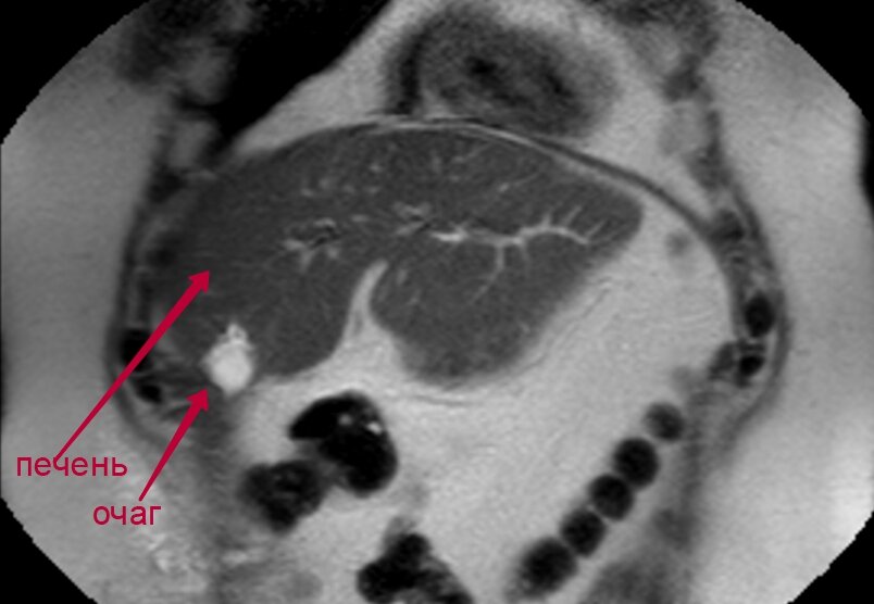 Снимок МРТ-обследования, на котором рентгенолог обнаружил подозрительный очаг