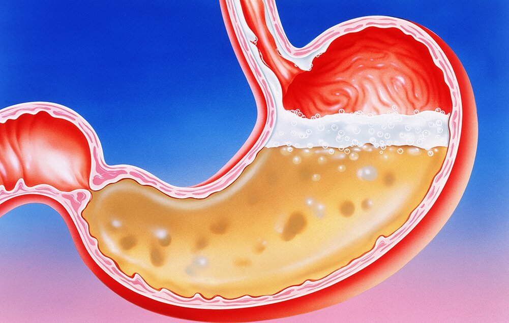 Эритематозная гастропатия. Кислотность желудка язва желудка