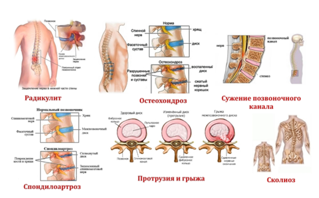 Поясничная грыжа симптомы у женщин фото Коррекция позвоночника Первая Медицинская Клиника Дзен
