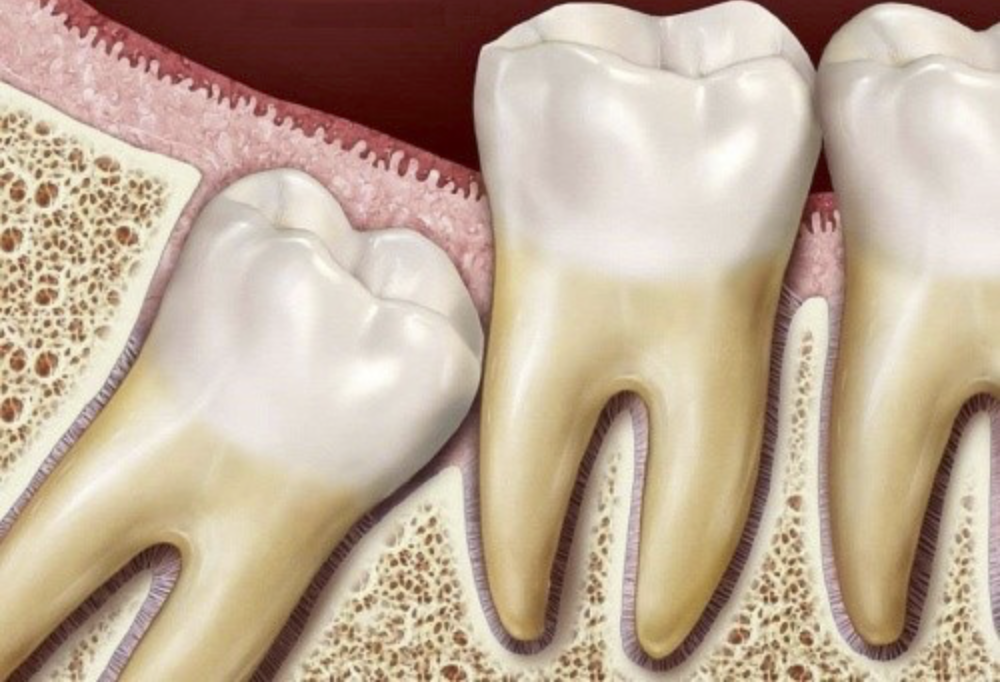 Так выглядит ретенция восьмерки с наклоном, которая угрожает корням соседнего зуба