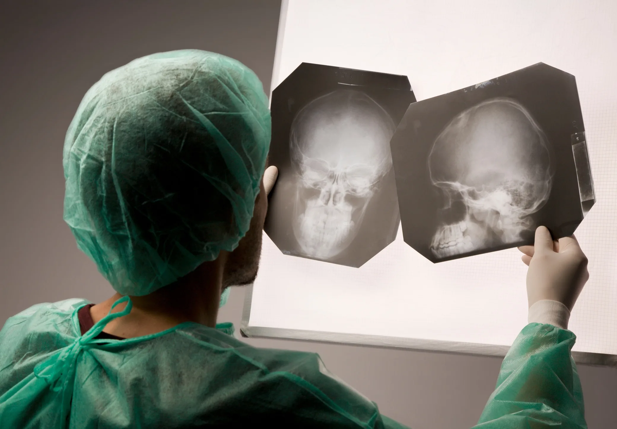 Сотрясение тканей. Рентген черепа сотрясение мозга. Закрытая черепно мозговая травма рентген. Черепномазштвая травма. Черепномозговые травы.