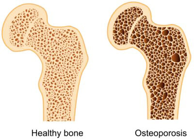 Здоровая кость и кость с остеопорозом