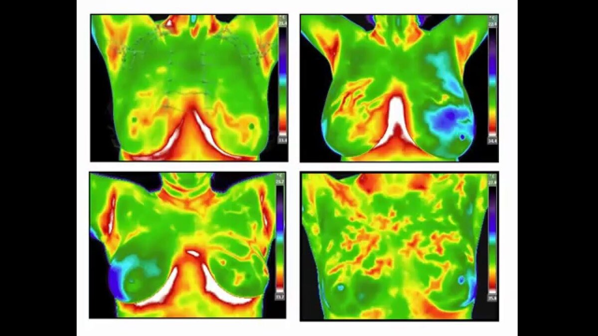 Медицинская термография презентация