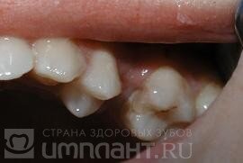 Фото с сайта  Имплант.ру https://www.implant.ru/vosstanovit-zub.html