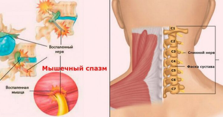 Как снять спазм мышц шеи, лечение мышечного спазма | Клиника Temed