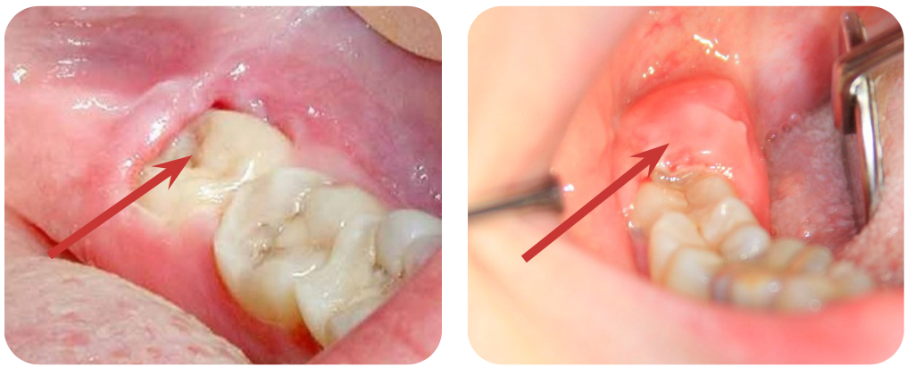 Рис. 1. Восьмые зубы на обоих фото частично покрыты слизистой, которая воспалилась. Посещение врача должно состояться, как можно быстрее, чтобы воспалительный процесс не перешел на нижележащие мягкие ткани 