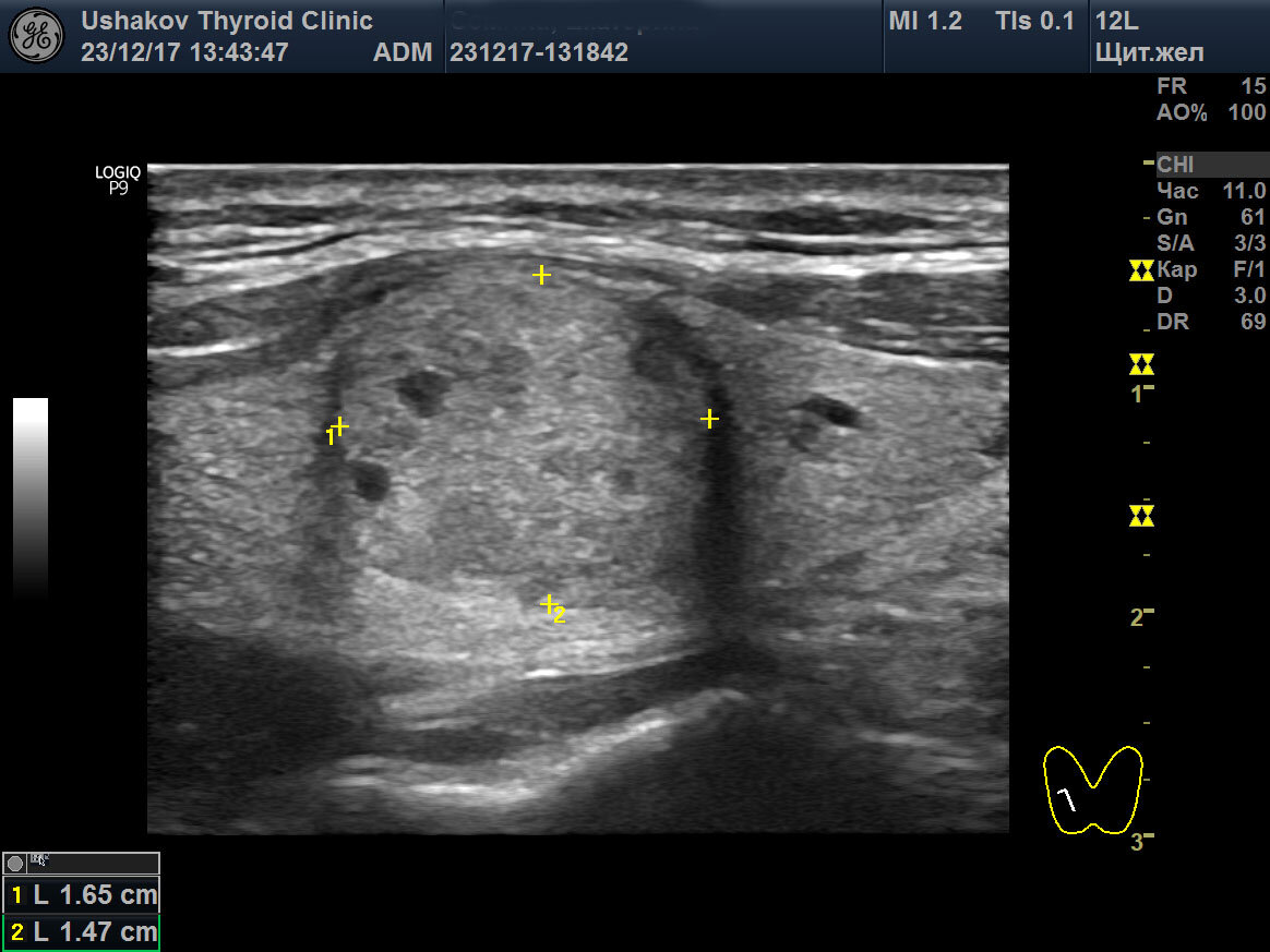 Гипоэхогенный узел щитовидной железы на УЗИ. УЗИ щитовидной железы ti-rads2. УЗИ ti rads 4б. Кровоток щитовидной железы УЗИ.