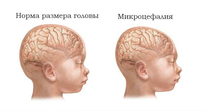 Люди с микроцефалией фото