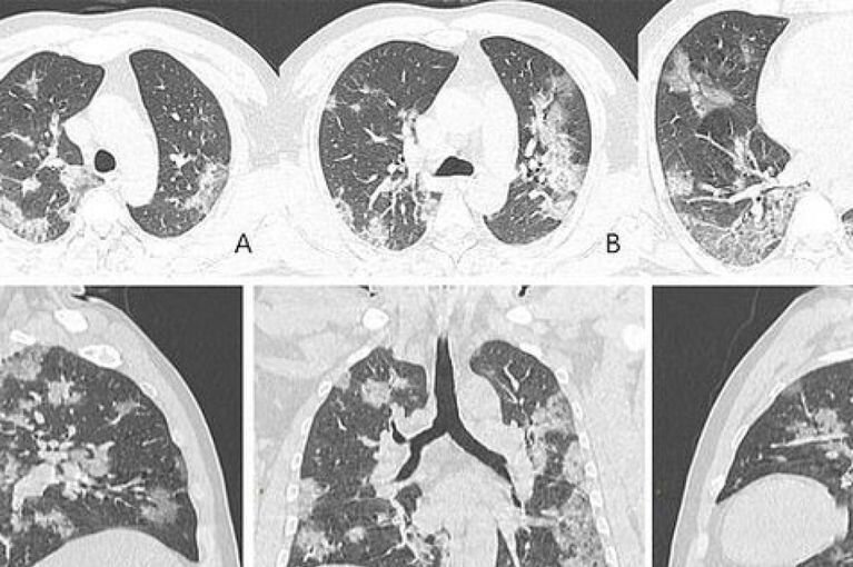 Томография зараженного пациента