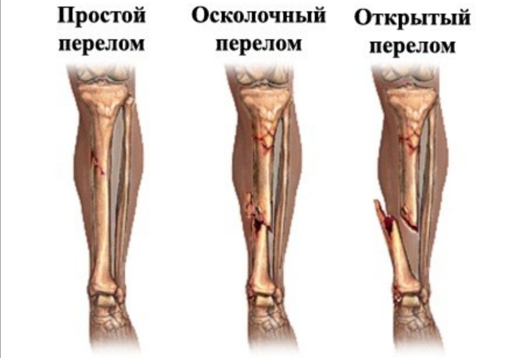 Открытый перелом