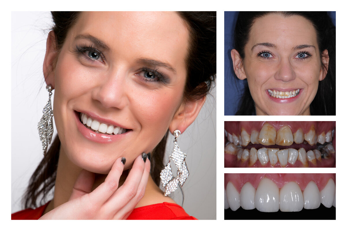 Исправление кривых зубов винирами фото до и после