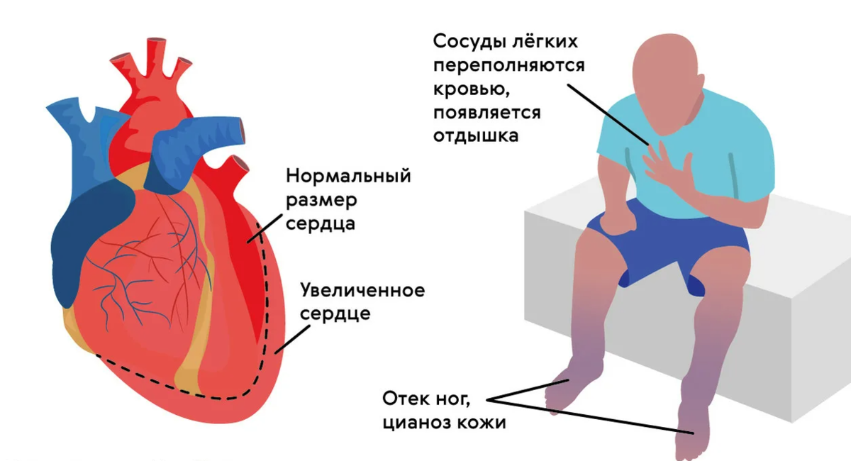 Блокада проводящей системы сердца ЭКГ. Типы блокад сердца на ЭКГ. Блокады сердца клинические проявления. Блокада левого предсердия.