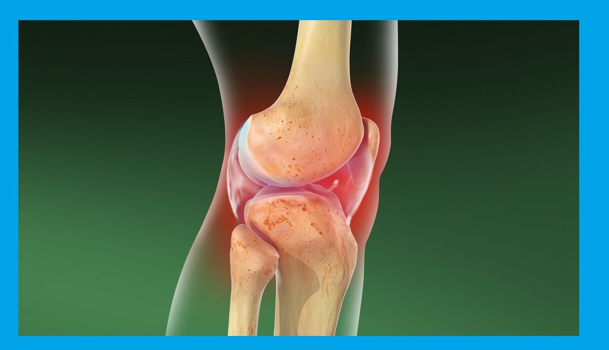 Обезболивающие препараты для облегчения боли при артрите