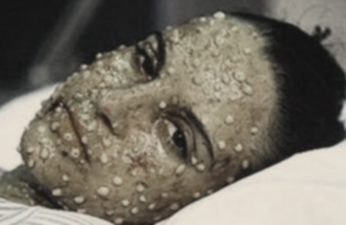 Больная оспой женщина