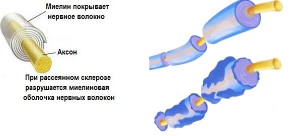 Миелиновая оболочка нервных волокон. Рассеянный склероз миелиновая оболочка. Разрушение миелиновой оболочки. Миелиновая оболочка нерва.