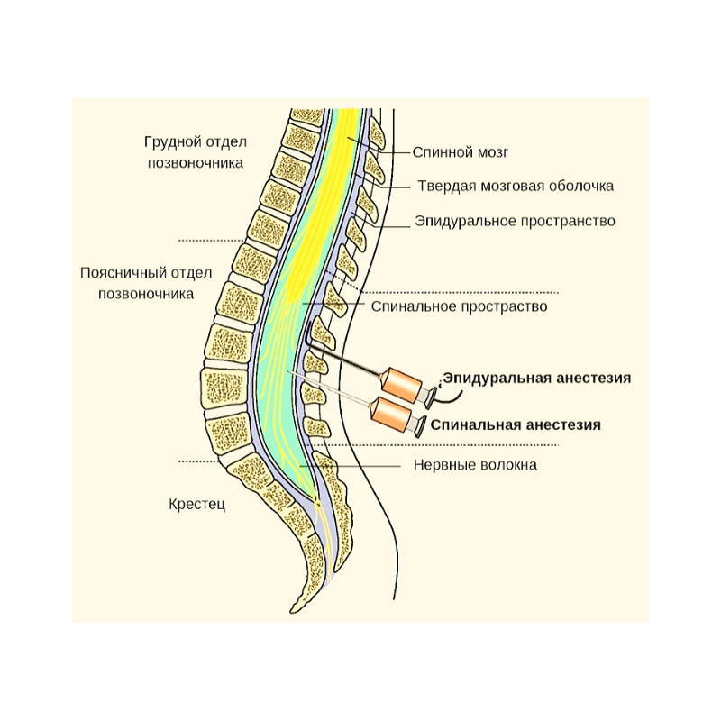 Эпидуральная спинная. Эпидуральное пространство спинного мозга. Эпидуральная анестезия катетер. Спинальная и эпидуральная анестезия. Эпидуральная анестезия игла.