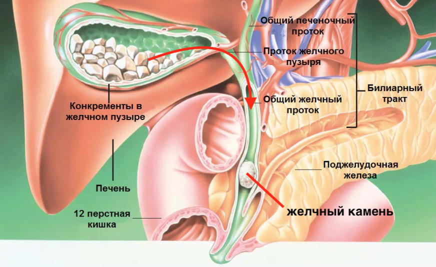 Болят желчные протоки. Желчные камни в протоке поджелудочной железы. Конкременты печеночных протоков. Анатомия человека желчный пузырь расположение. Желчный пузырь с камнями анатомия.