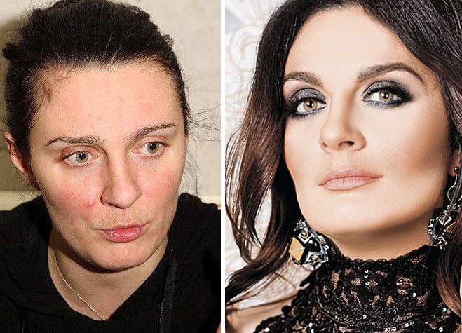 Ваенга пластика до и после