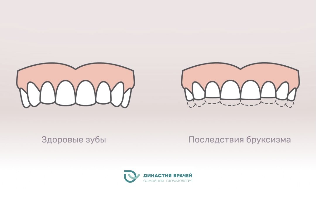 Бруксизм это что такое у взрослых. Бруксизм это что такое у взрослых