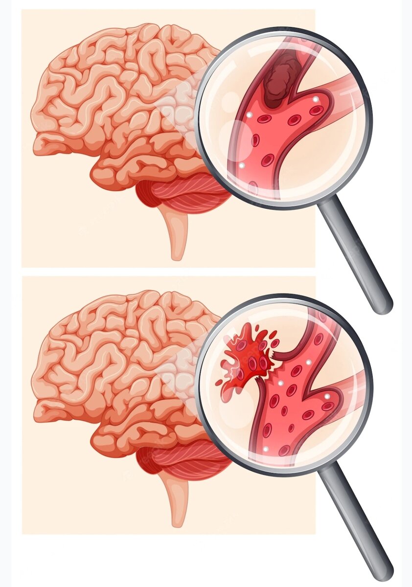 Ишемический инсульт (тромб блокирует просвет артерии, питающей головной мозг; изображение выше) и геморрагический инсульт (разрыв стенки кровеносного сосуда приводит к излиянию крови в ткань мозга; изображение ниже)