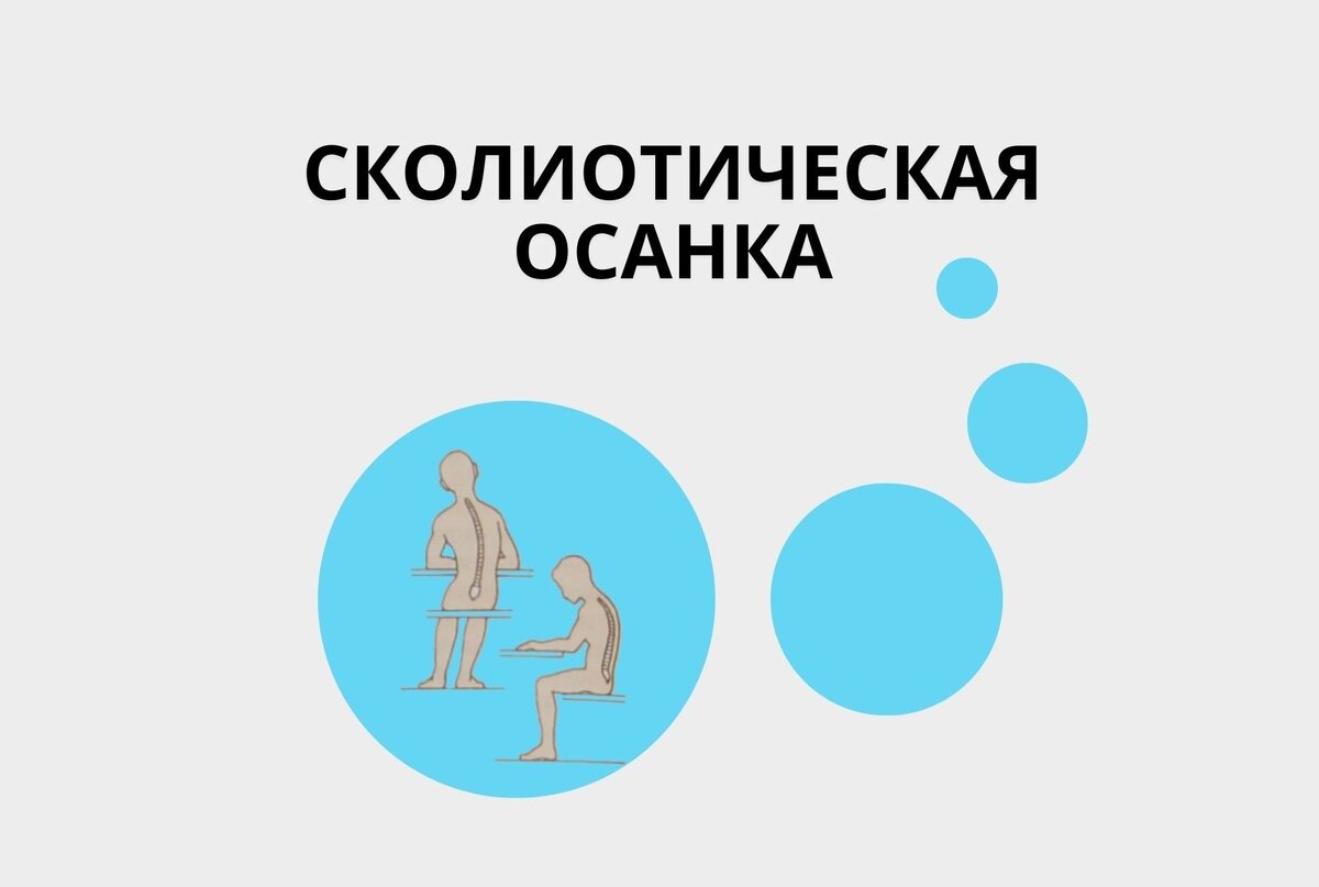 Сколиотическая осанка
