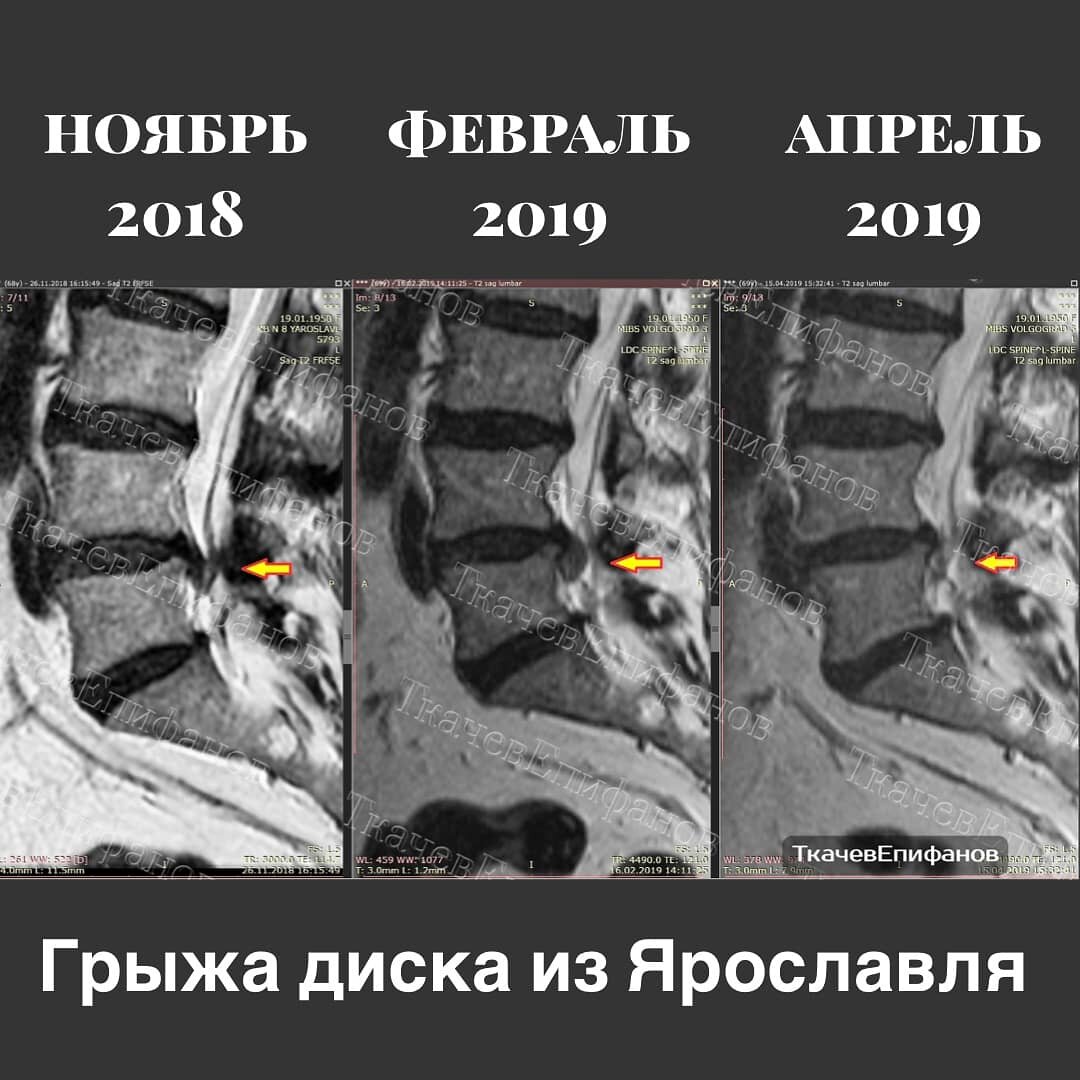 Резорбция грыжи. Резорбция секвестрированной грыжи. Резорбция грыжи шейного отдела.