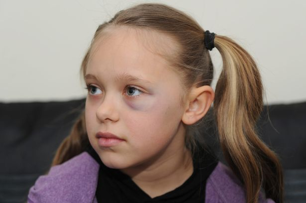 Только фонарь горел у меня под глазом