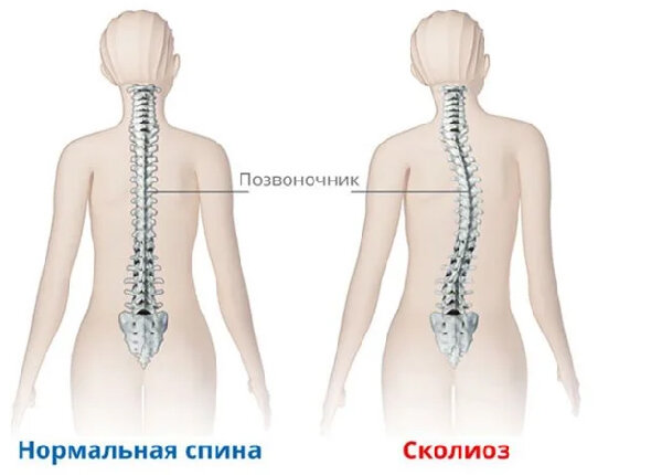 Если одно плечо выше другого или шея уходит в бок , то деформация позвоночника уже имеется. 