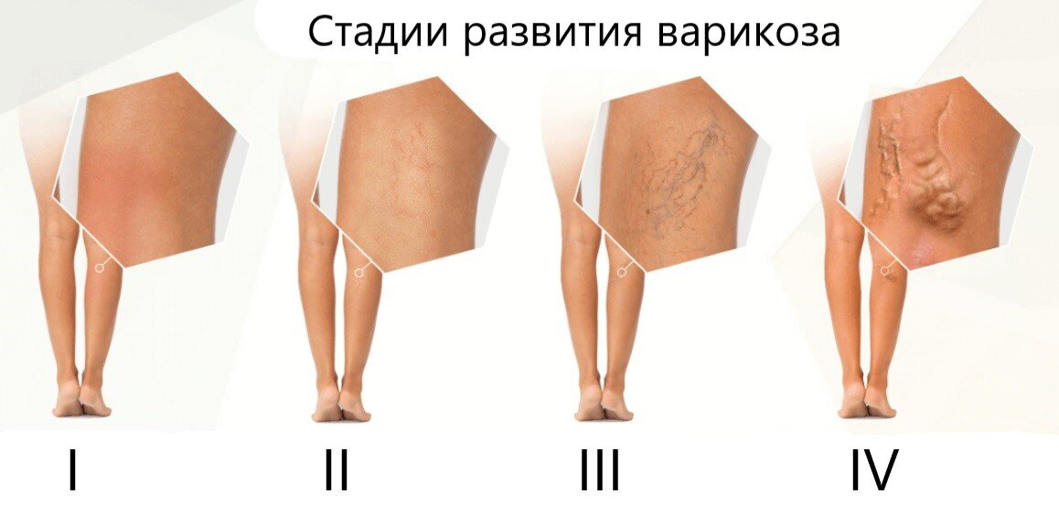 Стадии варикоза