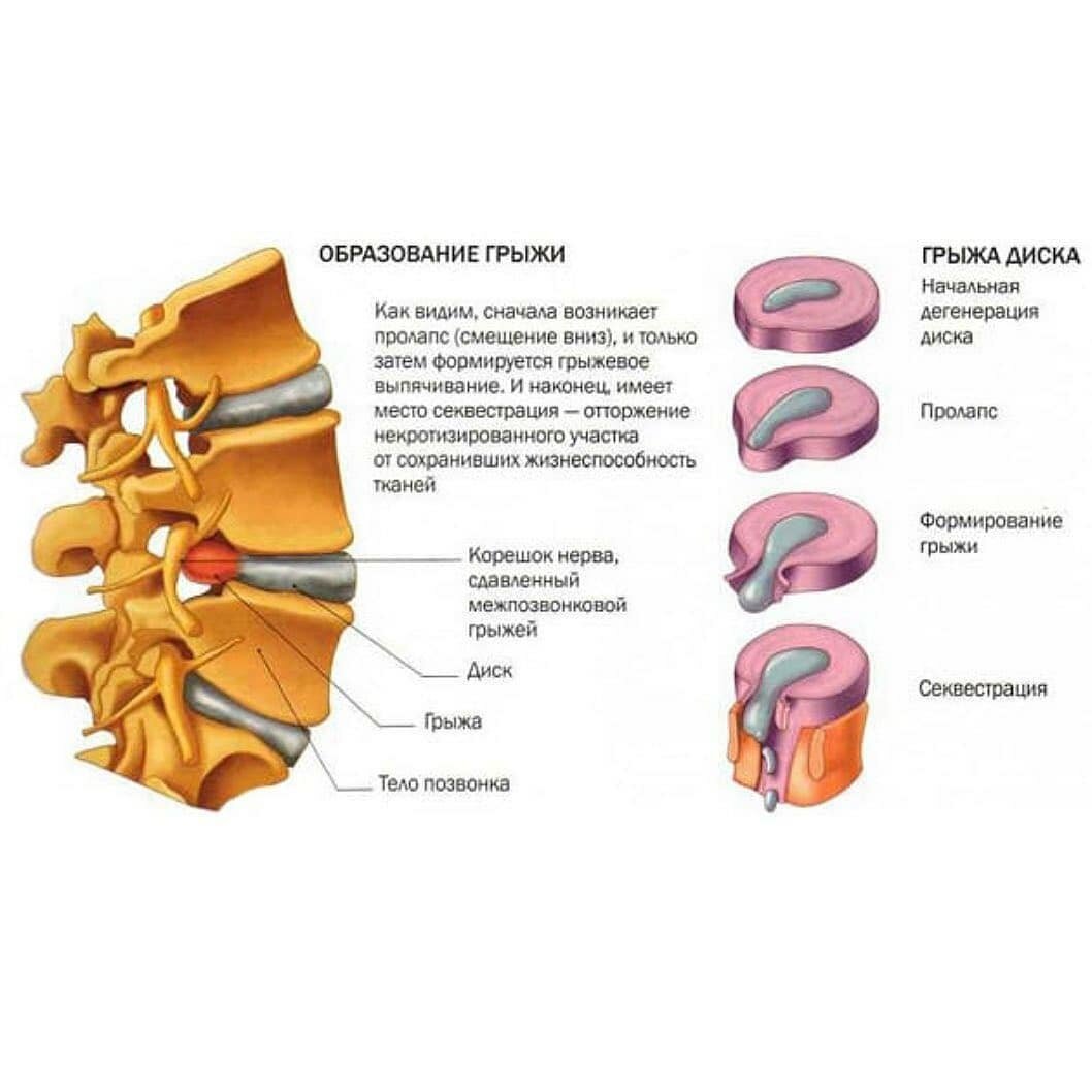 Почему появляется грыжа? | Растяжка с Кутузовой | Дзен