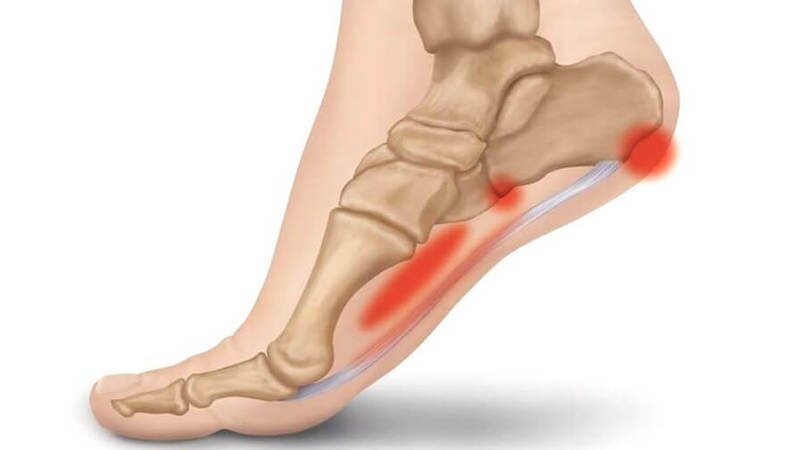 Воспаление при плантарном фасциите.