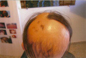 Лидиа, 14 лет, 6 месяцев мезотерапия , плюс кортикоиды.Многие часто приписываемые медикаменты могут вызывать временное и постоянное выпадение волос, а также являться источником облысения мужского и женского типов. Следует отметить, что приведенный в этой статье список лекарств не включает медикаменты, используемые при химио- и радио- терапиях. Ваш лечащий врач, приписывая то или иное лекарство, может не упомянуть о выпадении волос, являющемся его побочным эффектом, поэтому не забудьте осведомиться об этом и внимательно ознакомиться с инструкцией перед его применением. Кроме того, эту информацию может предоставить Вам фармацевт, к которому Вы обратитесь за приобретением лекарств.
Справочные пособия, содержащие сведения о различных медикаментах, которые продаются в аптеках и книжных магазинах, также являются надежным источником о свойствах лекарств, отпускаемых по рецепту. Если врач рекомендует Вам принимать препарат, побочным эффектом которого, является выпадение волос, спросите его о возможности замены этого лекарства аналогичным по воздействию, но не приводящим к облысению.
Лекарства, вызывающие выпадение волос, сгруппированы в списке по категориям, согласно их назначению. Вначале приводится патентованное название лекарственного средства, а затем в скобках видовое наименование. В некоторых категориях отдельные лекарства не упоминаются. Желая избавиться от того или иного недуга и не допустить такого побочного эффекта, как выпадение волос, обратитесь к этому списку.
Угревая сыпь. Все лекарства, являющиеся производными витамина А, использующиеся для лечения угревой сыпи, включая:
Акутан (изотретиноин)
Кровь
Антикоагулянты (противосвертывающие препараты), включая:
Панварфин (варфарин натрия)
Софарин (варфарин натрия)
Кумадин (варфарин натрия)
Инъекции гепарина
Холестерин
Лекарства, понижающие уровень холестерина, включая:
Атромид-С (клофибрат)
Лопид (гемфиброзил)
Судороги/эпилепсия
Антиконвульсанты Депрессия
Антидепрессанты, включая:
Анафранил (кломипрамин)
Элавил (амитриптилин)
Норпрамин (дезипрамин)
Памелор (нортриптилин)
Паксил (пароксетин)
Прозак (флуоксетин)
Синекван (доксепин)
Сурмонтил (тримипрамин)
Тофранил (имипрамин)
Вивактил (протриптилин)
Золофт (сетралин)
Диета/Потеря веса
Амфетамины
Грибки
Антигрибковые средства
Глаукома
Бета-блокаторы, включая:
Тимоптик, глазные капли (тимолол)
Тимоптик Окудоз (тимолол) Подагра
Зилоприм (аллопуринол)
Сердце/повышенное артериальное давление
Многие лекарства, приписываемые при сердечных болях, в том числе и бета-блокаторы, которые также используются для лечения повышенного артериального давления, включая:
Теномин (атенолол)
Лопрессор (метопролол)
Коргард (надолол)
Индерал и Индерал ЛА (пропанолол)
Блокадрен (тимолол)
Гормональные расстройства
Все гормоносодержащие препараты и лекарства, которые приписывают при необходимости решить проблемы, связанные с репродуктивными возможностями мужчин и женщин, потенциально могут вызвать процесс выпадения волос. К ним относятся: Противозачаточные таблетки
Гормонозаместительная терапия (ГЗТ) для женщин (эстроген или прогестерон)
Мужские андрогенные гормоны и все формы тестостерона
Стероидные анаболические средства
Преднизон и другие стероиды Воспаление
Многие противовоспалительные средства, включая те, что приписывают при локализированных болях, опухолях или повреждениях.
Противоартритные препараты
Нестероидные противовоспалительные средства, включая:
Напросин (напроксен)
Анапрокс (напроксен)
Анапрокс ДС (напроксен)
Индосин (индометацин)
Индосин СР (индометацин)
Клинорил (сулиндак) Противовоспалительные препараты, которые также используются при химиотерапии:
Метотрексат (MTК)
Ревматрекс (метотрексат)
Болезнь Паркинсона
Леводопа/Л-допа (Допар, Ларадопа)
Расстройства щитовидной железы
Ряд лекарств, используемых для лечения щитовидной железы (необходимо консультироваться с доктором).
Язва желудка и 12-перстной кишки Многие лекарства, применяемые для лечения расстройств пищеварения, проблем с желудком и язв, включая безрецептурные и рецептурные дозировки.
Тагамет (циметидин)
Зантак (ранитидин)
Пепсид (фамотидин