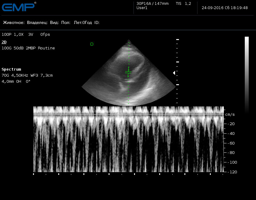 Импульсно-волновая допплерограмма трансаортального потока, выполняется из левой апикостернальной 5-камерной позиции, строб выставлен перед аортальным клапаном