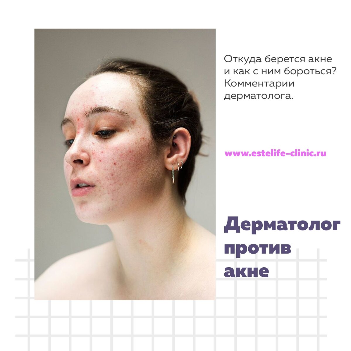 Есть ли жизнь без акне?