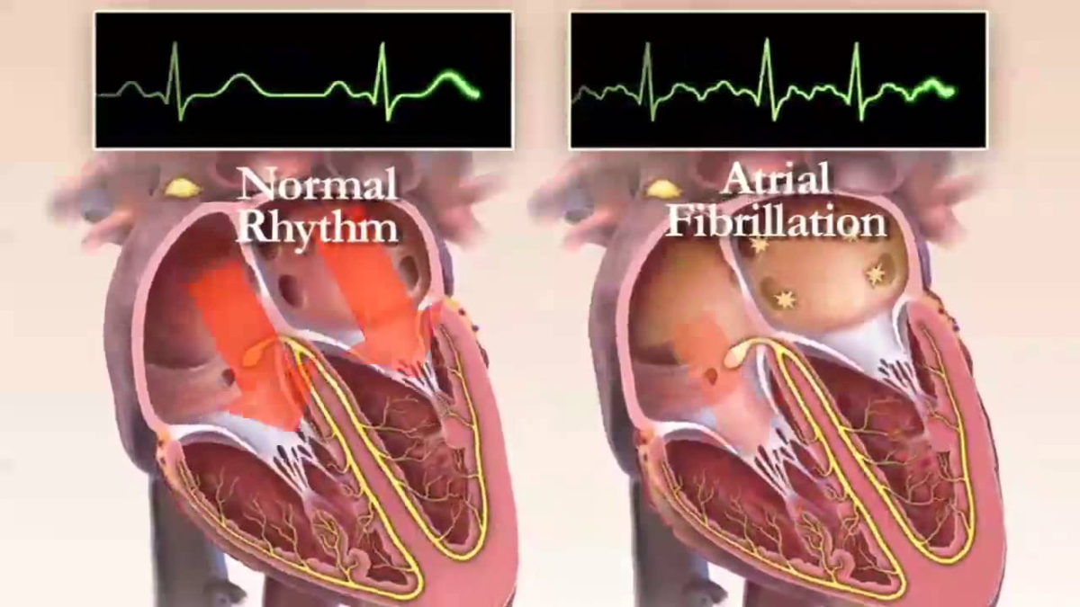 Мерцательная сердце. Фибрилляция предсердий. Фибрилляция предсердий анимация. Аритмия. Мерцательная аритмия гиф.