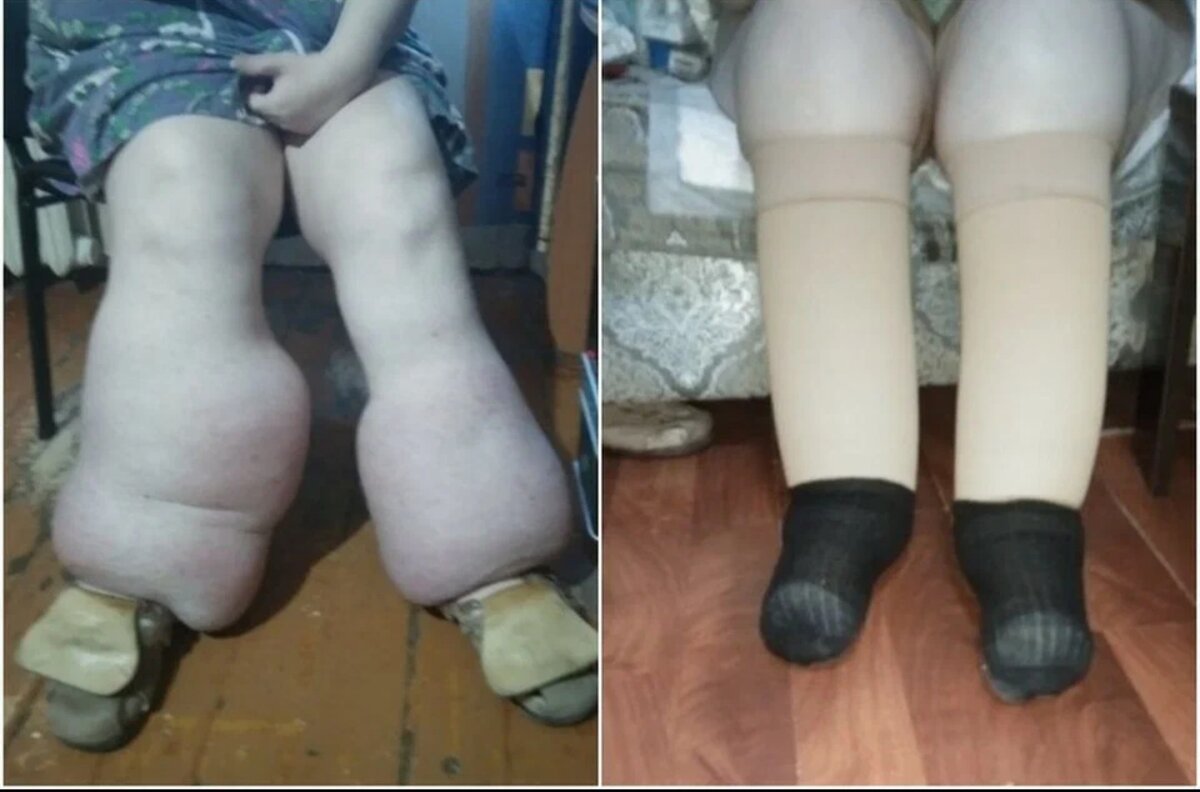 Фото ног: до/после