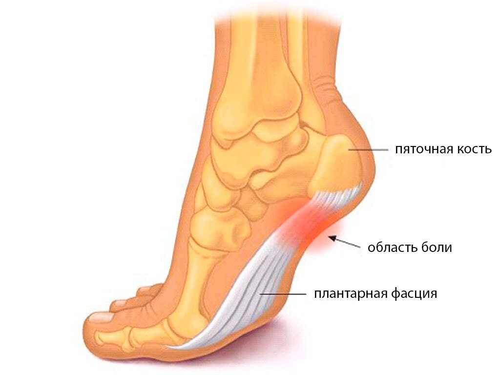 Проблема — в фасции, а не в костном выступе. Источник: liqmed.ru