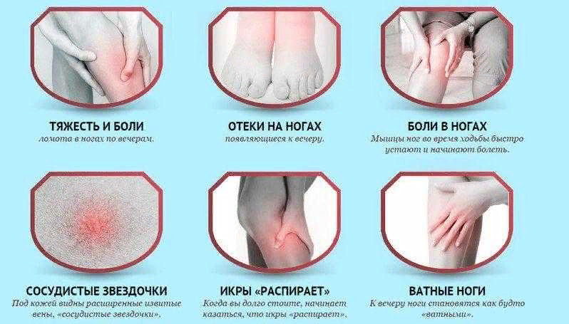варикозное расширение вен, варикоз, больные вены, боли в венах