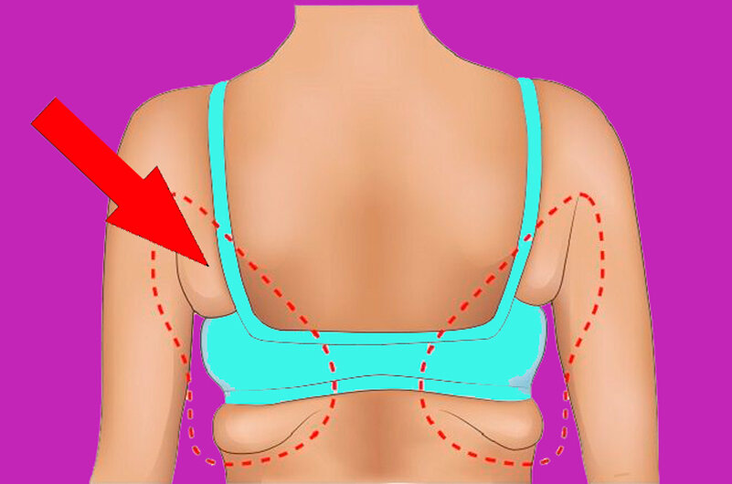 Как убрать жировое отложение. Складки под лифчиком. Складки под лифчиком на спине.