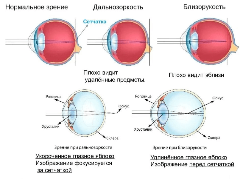 Что делать, если стремительно падает зрение?