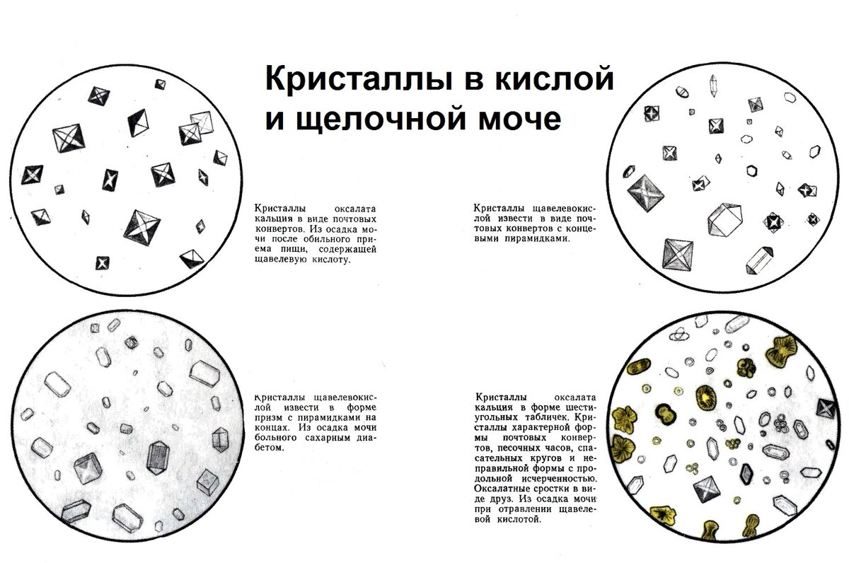 Общий анализ мочи: методы исследования, расшифровка микроскопии осадка мочи