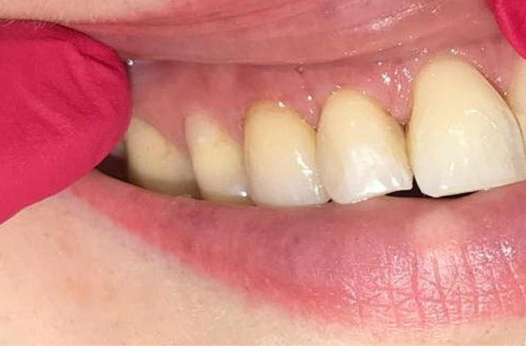 Острая боль при надкусывании через время после протезирования-сигнал для повторного визита к специалисту