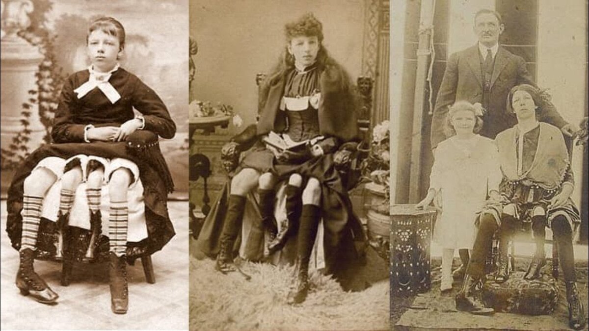 Жозефин Миртл Корбин (Josephene Myrtle Corbin), родилась в 1868 году в Техасе. Когда она родилась, врачи думали, что у неё четыре ноги. Но потом выяснилось, что у девочки два полностью развитых таза, она могла ходить на всех четырех ногах, однако, вторые ноги были очень слабыми. Её артистическая карьера началась, когда ей был всего 1 месяц. Ее родители начали показывать за деньги соседям. Люди платили по 10 центов, чтобы увидеть четырехногую девочку. Выступать в шоу она начала с 13 лет. Юная артистка собирала большие толпы зрителей, работая на братьев Риллинг и Кони-​Айленд.
Миртл Корбин была настолько популярной, что под неё стали работать несколько фиктивных актрис. Уже в юном возрасте Корбин сделала себе не плохое состояние, и могла позволить себе не работать. Девушка вышла замуж за наблюдавшего ее врача - Джеймса Клинтона Бикнелла. Она родила ему четырёх дочерей и сына. Умерла Корбин в 1928 году. Для медицины она стала очень уникальным случаем. Врачи обнаружили, что половые органы обоих её тазов были функциональными.
