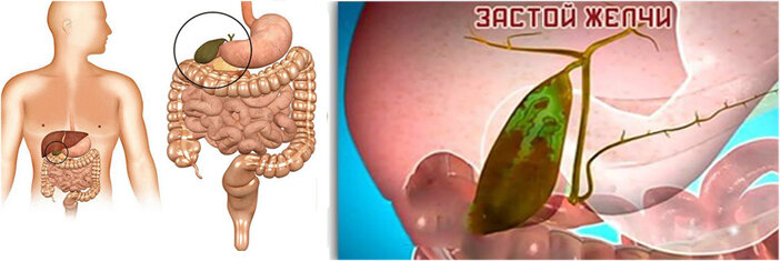 Какой стул при застое желчи в желчном пузыре